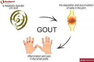 Cơ chế và cách điều trị bệnh gout