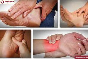Triệu chứng đầu tiên của bệnh gout là sưng nóng đỏ đau vị trí bàn chân, cổ tay, cổ chân
