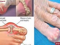 Các biểu hiện bệnh gout phổ biến nhất
