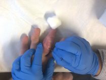 Tiểu phẫu loại bỏ hạt tophi dạng mềm tại bàn tay