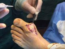 Phẫu thuật cắt bỏ hạt tophi kết tủa tại ngón chân cái