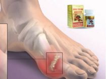 Triệu chứng lâm sàng của bệnh gout