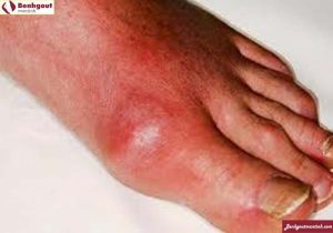 Bệnh gout và cách phòng tránh bệnh gout an toàn hiệu quả nhất