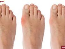 Phát hiện nhanh các triệu chứng của bệnh gout