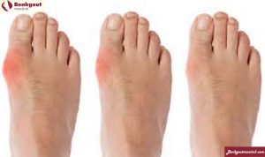 Triệu chứng bệnh gout giai đoạn đầu là đau vị trí ngón chân cái