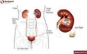 Hầu hết các bệnh nhân mắc gout đều bị suy thận, tiểu buốt tiểu rắt..