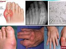 Tác hại bệnh gout là gì?