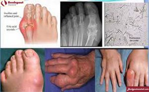 Bệnh gout gây đau đớn, biến dạng khớp và các bệnh liên quan khác: suy thận, tim mạch, huyết áp...