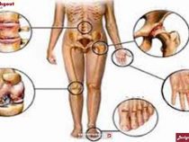 Các triệu chứng bệnh giả gout